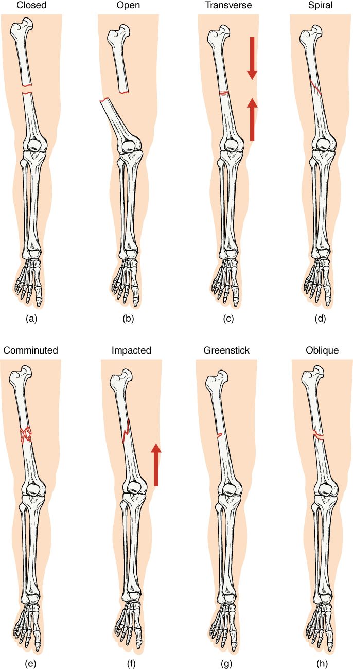 Drawings of different kinds of broken bones