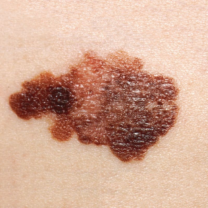 Burns and skin cancer reference figure