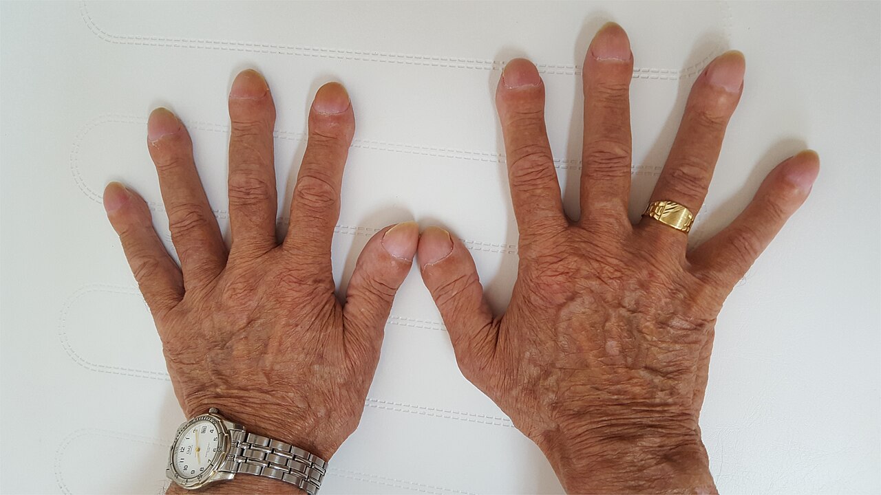 The normal nail base angle is about 160 degrees; flattening beyond 180 degrees defines clubbing and signals chronic hypoxia.