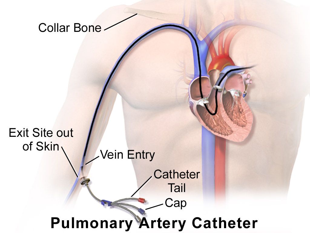 Cross-section of the heart showing the four chambers, the tricuspid, pulmonic, mitral and aortic valves, and the direction of blood flow through the pulmonary and systemic circuits