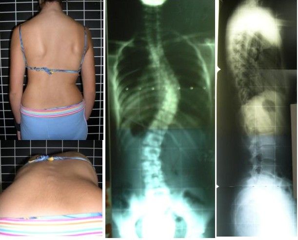 The Adams forward bend test makes a rotational spinal deformity visible as an asymmetric rib hump that is invisible when the patient stands upright.