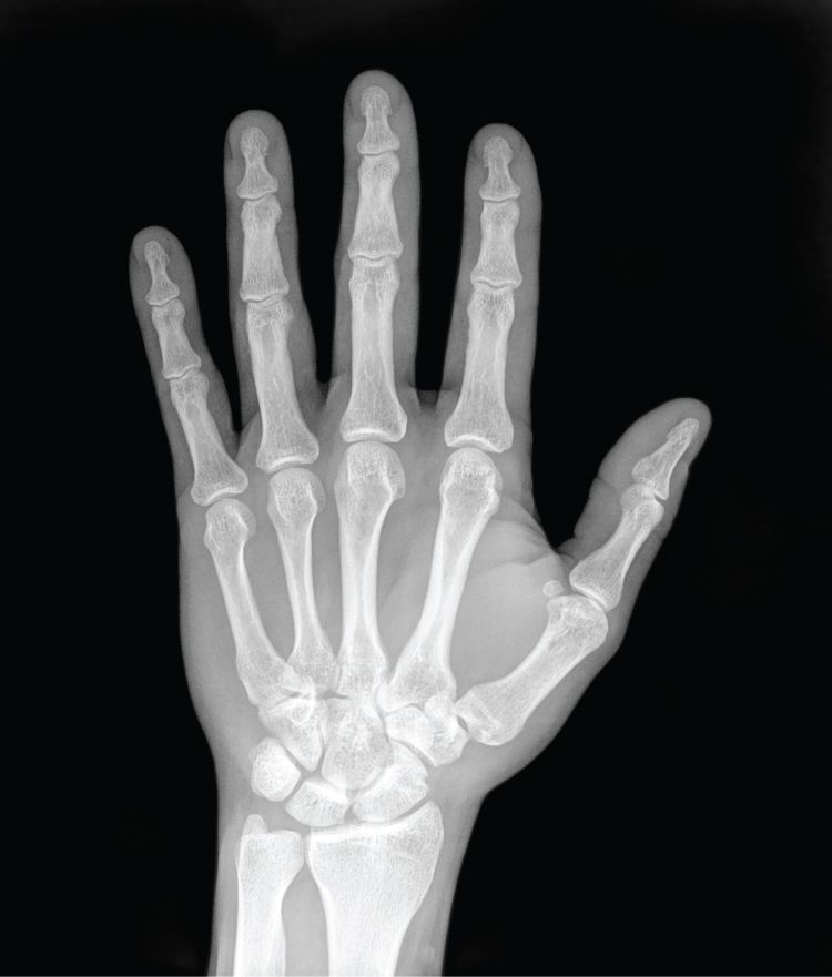 X-ray of a child's hand showing the bones and open growth plates