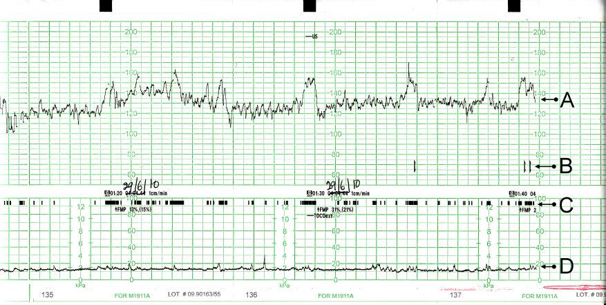 Electronic fetal monitoring produces two synchronised traces — fetal heart rate above, uterine activity below — and the relationship between them is the whole interpretation.