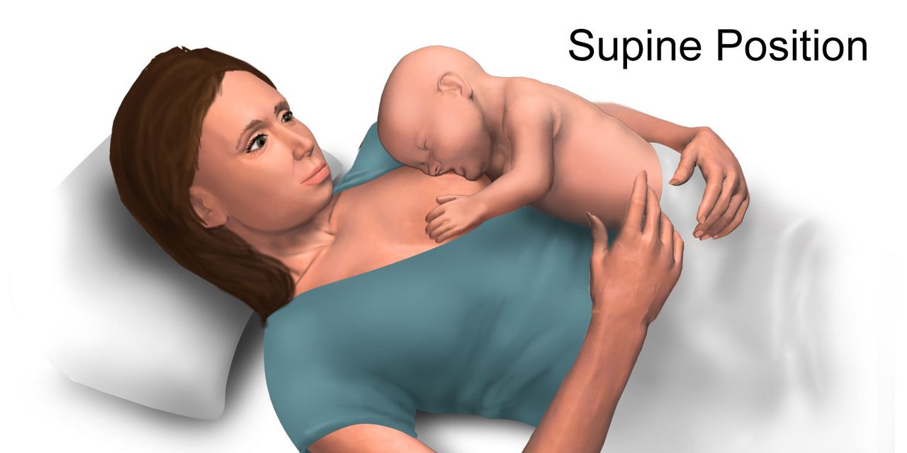 Illustration of epidural catheter placement in the lumbar epidural space with the patient positioned curled on their side
