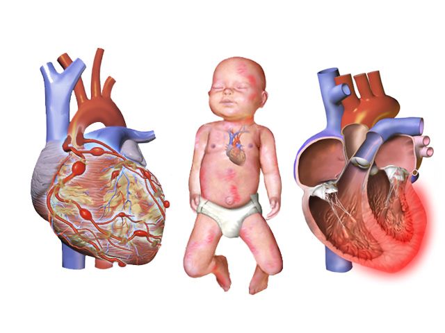 Illustration of Kawasaki disease showing coronary artery aneurysms along the epicardial vessels and a polymorphous rash over the trunk and limbs of an infant.