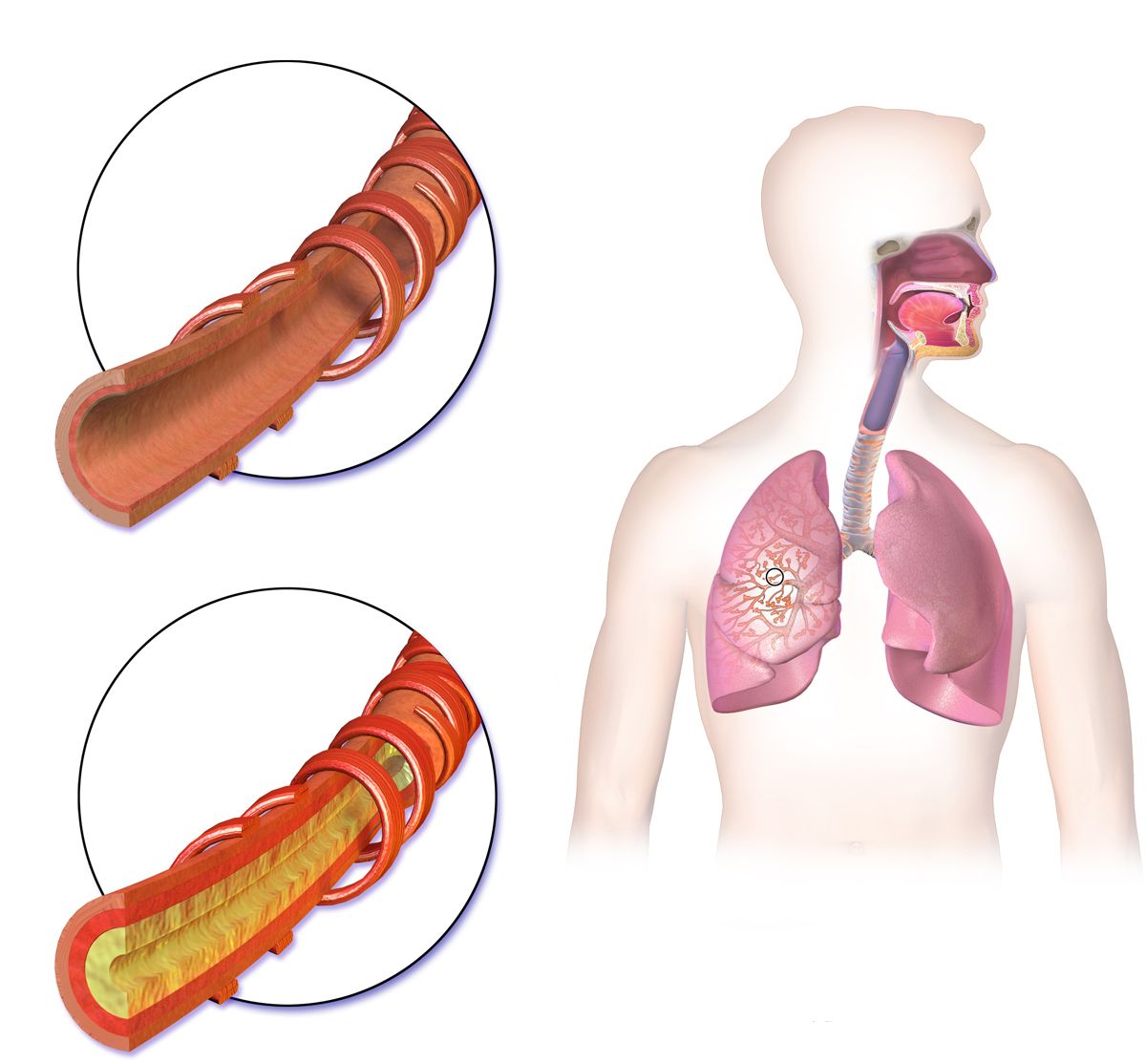 Illustration contrasting healthy alveoli with the enlarged destroyed air spaces of emphysema and an inflamed mucus-filled bronchus of chronic bronchitis