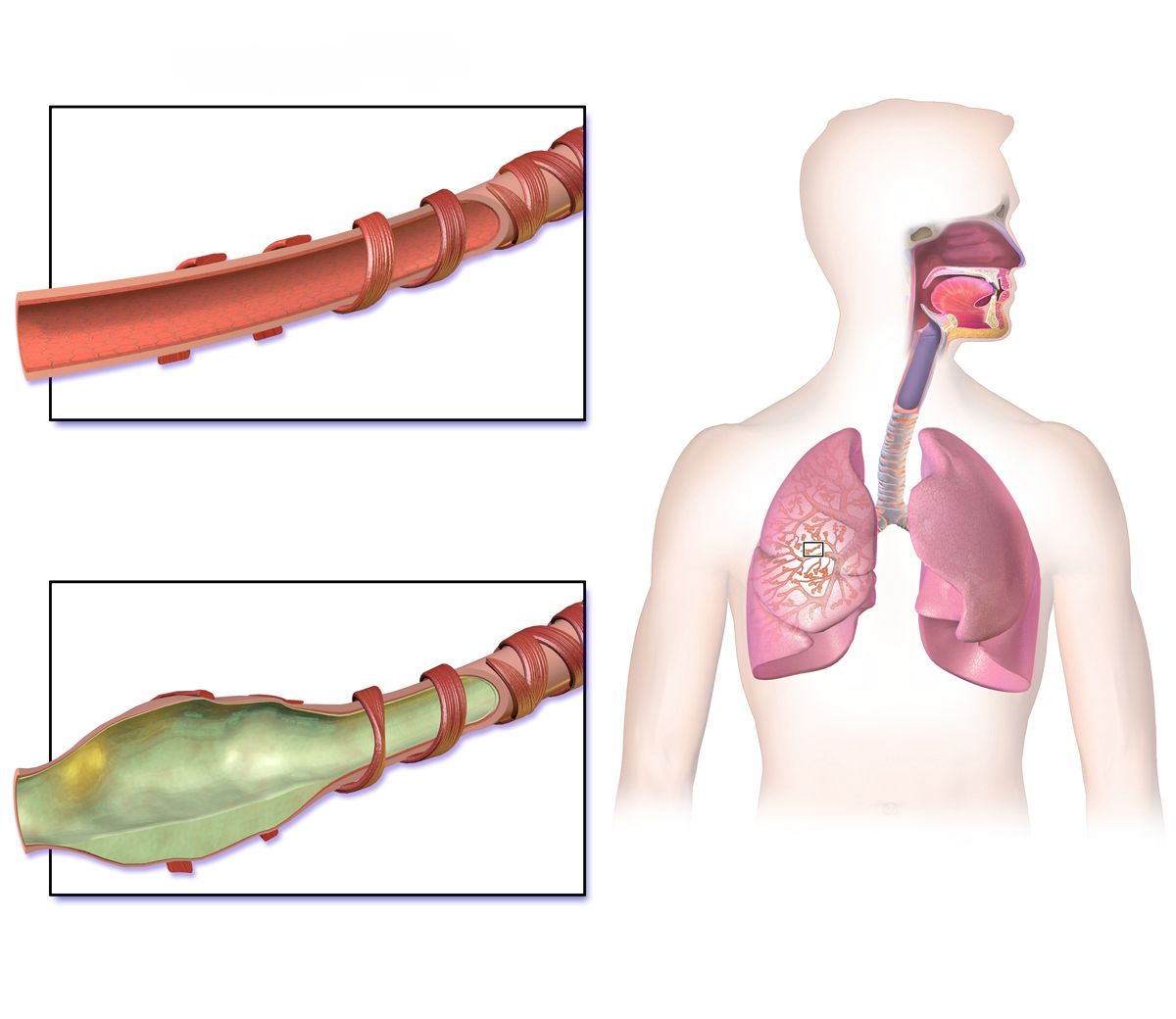 High-resolution chest CT image showing dilated thick-walled bronchi consistent with bronchiectasis