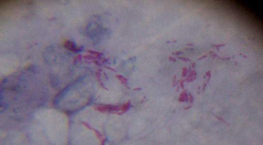 Acid-fast bacilli on Ziehl–Neelsen stain — the waxy mycolic-acid cell wall that retains carbolfuchsin is the same wall that makes tuberculosis slow to grow and slow to treat. CDC / Dr. Geo
