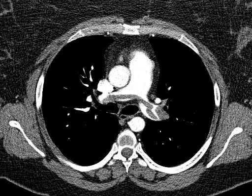 Saddle embolus on CT pulmonary angiography — the filling defect is clot occupying arterial lumen that should be filled with contrast.