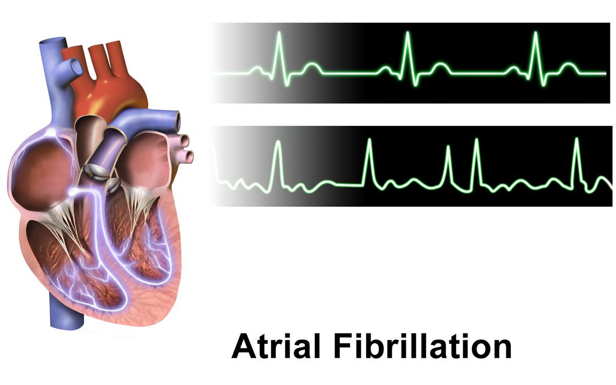 ECG rhythm strip demonstrating coarse ventricular fibrillation with chaotic waveforms of varying amplitude and no identifiable QRS complexes