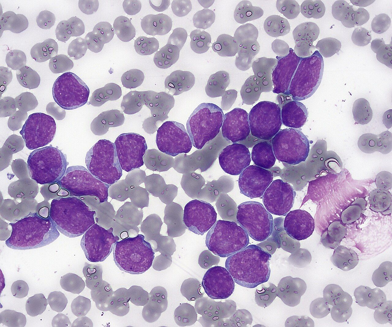 In acute leukemia the marrow fills with blasts that crowd out normal production, which is why the patient is anemic, neutropenic and thrombocytopenic at once.