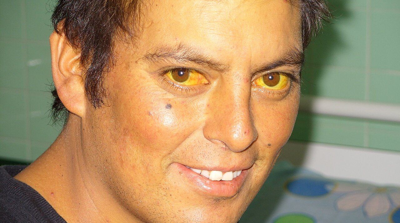 Scleral icterus appears before generalised skin jaundice and is the most reliable early sign across all skin tones.