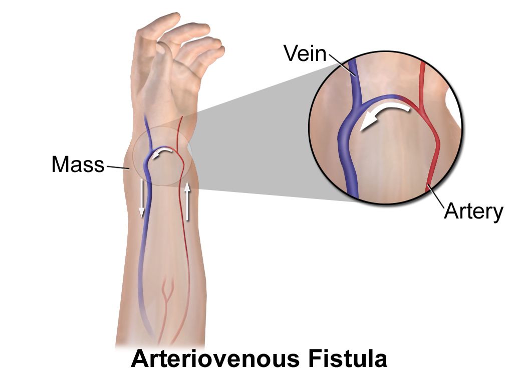 Schematic of a hemodialysis circuit showing blood flow from an arteriovenous fistula through the dialyser membrane against countercurrent dialysate flow