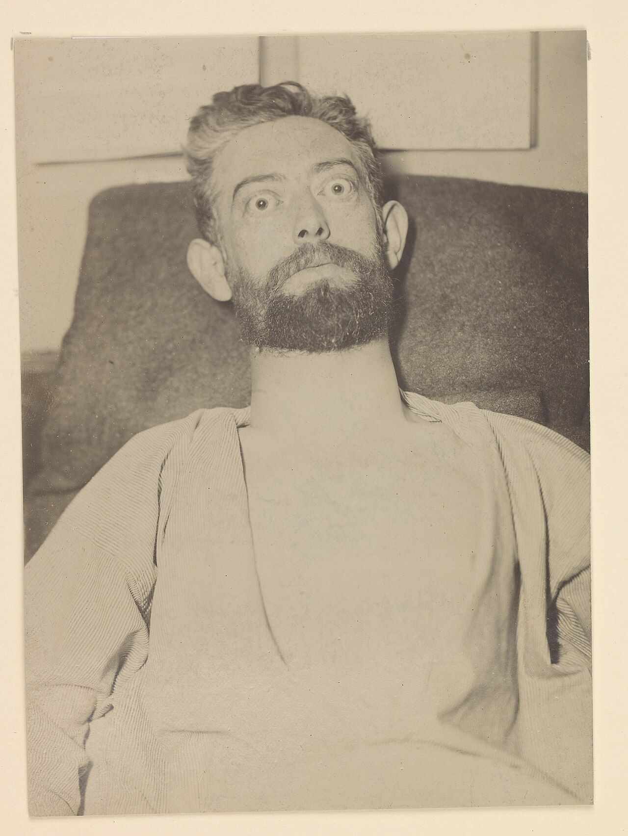 Diffuse goitre with exophthalmos and lid retraction &mdash; the thyroid-stimulating immunoglobulin of Graves disease acts on the gland and on the retro-orbital tissue at the same time.