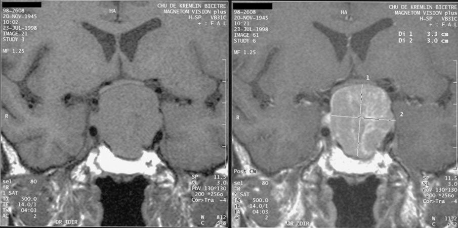 A macroadenoma expanding out of the sella compresses the optic chiasm from below, producing the bitemporal hemianopsia patients describe as missing the car in the next lane.