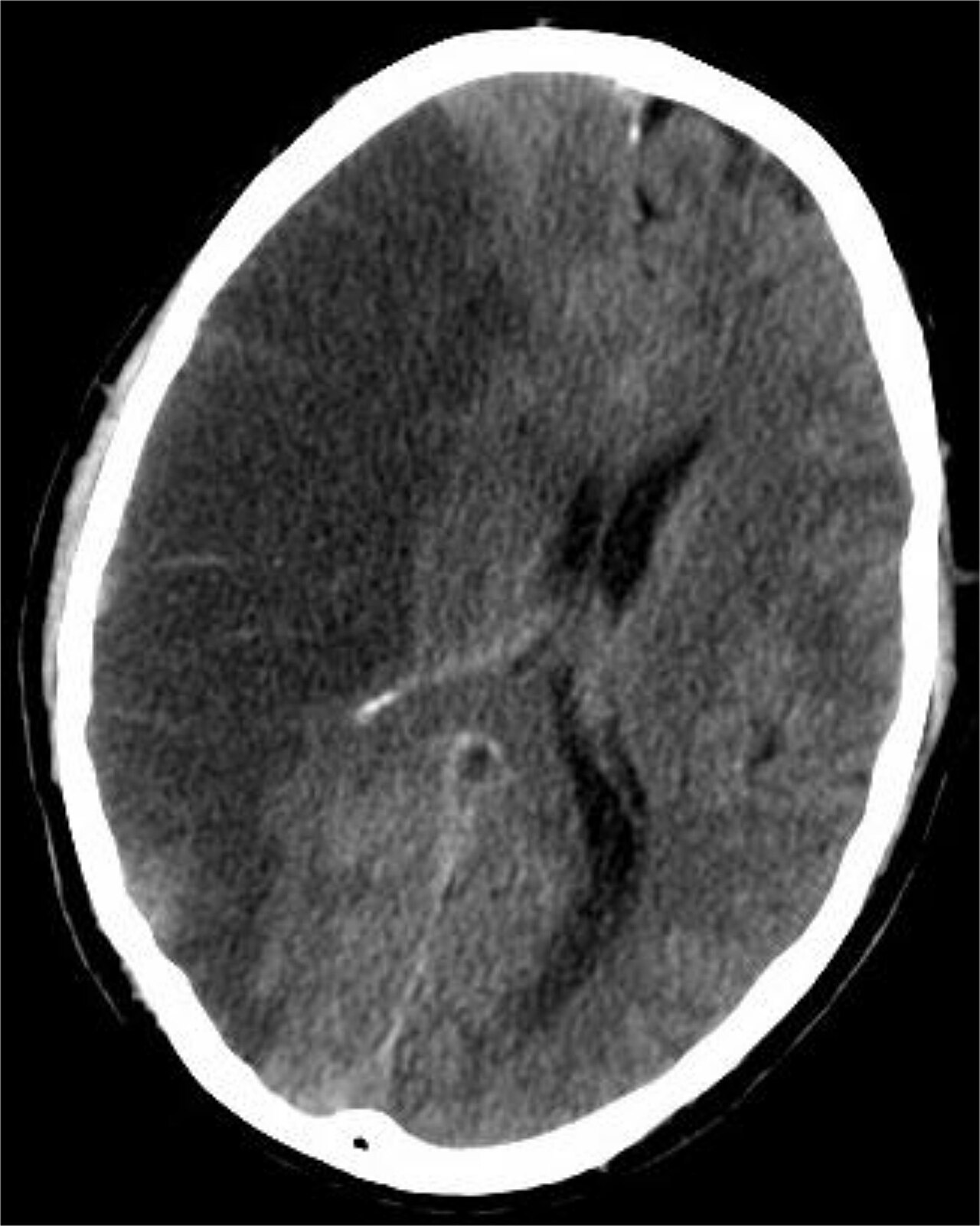 An established middle cerebral artery infarct appears as a hypodense territory on non-contrast CT, but in the first hours the scan is often normal — its job is to exclude blood, not to confirm i