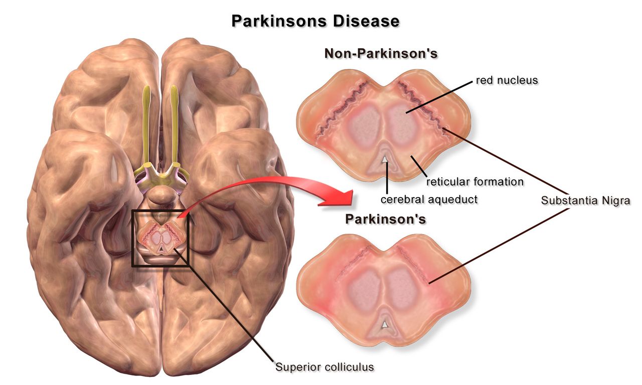 Illustration of a person with Parkinson disease showing stooped posture, flexed arms, masked facies and a shuffling festinating gait