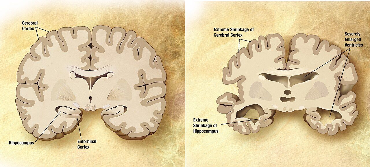 Cortical atrophy, widened sulci and enlarged ventricles in advanced Alzheimer disease compared with a healthy brain.
