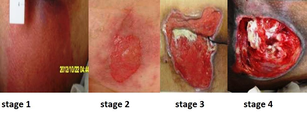 Progressive tissue loss across pressure injury stages, from non-blanchable erythema to exposed bone and tendon.