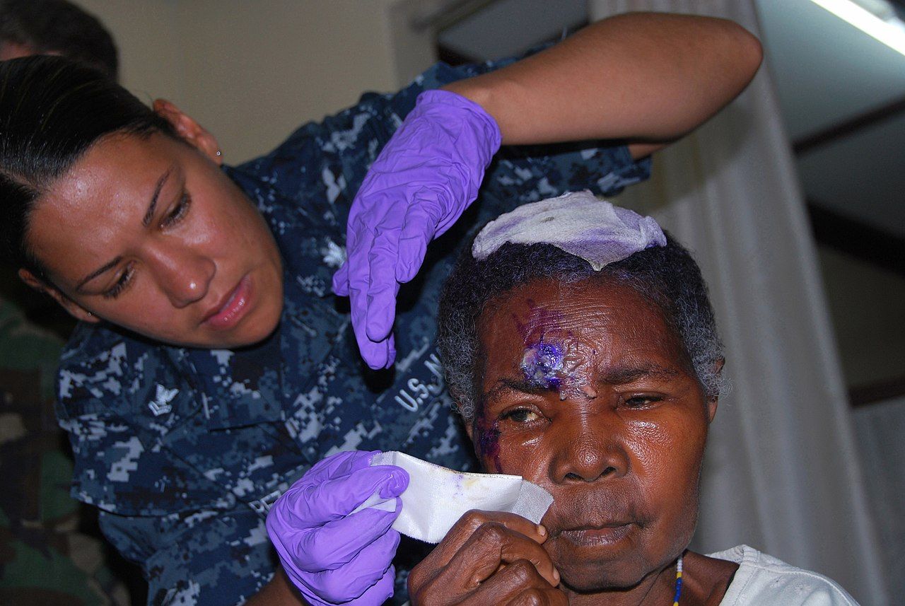 A dressed partial-thickness burn during the acute phase, when the dominant threat has shifted from shock to infection.