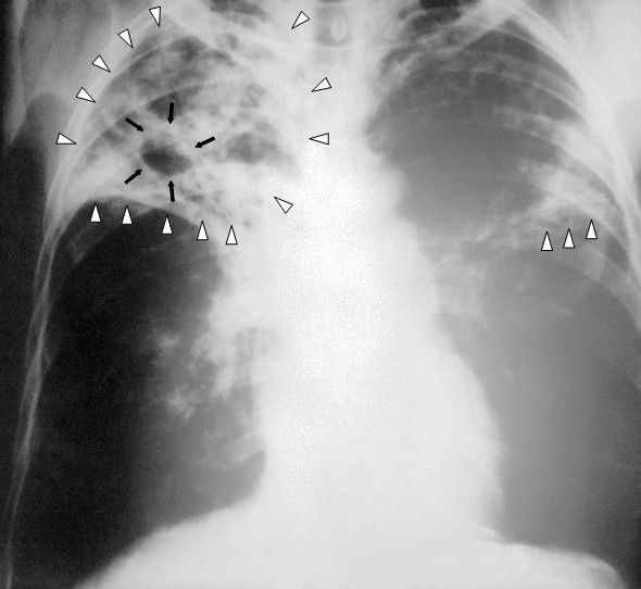 Upper-lobe cavitation on chest radiograph is the classic pattern of reactivation pulmonary tuberculosis and should trigger airborne precautions before any test result returns.