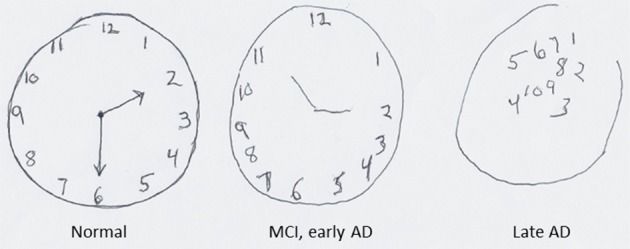The clock-drawing task screens executive function, planning and visuospatial ability in under a minute and pairs with three-word recall to form the Mini-Cog.