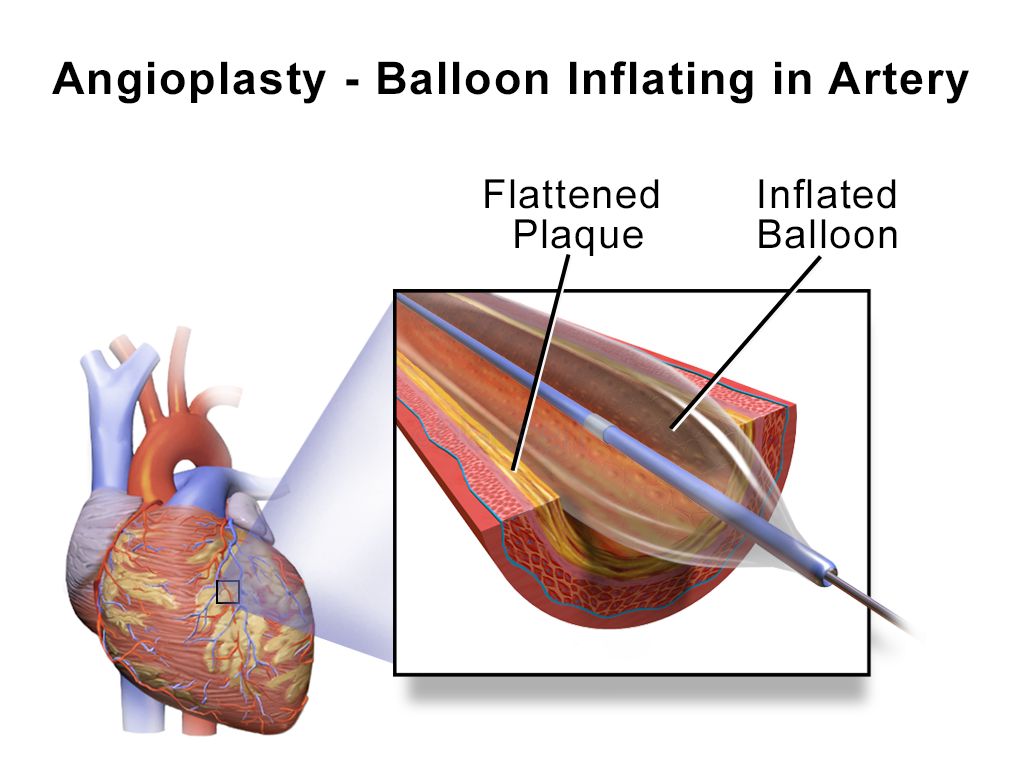 Illustration of coronary angioplasty showing a balloon catheter inflating inside a plaque-narrowed coronary artery and an expanded metal stent holding the vessel open afterward
