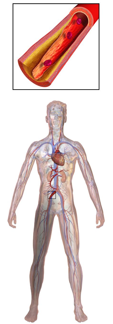Illustration of peripheral artery disease: a cutaway of an artery narrowed by yellow atherosclerotic plaque, shown above a whole-body figure mapping the arteries and veins
