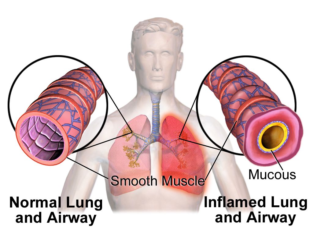Comparison illustration of a normal bronchiole and alveoli beside an asthmatic airway with bronchoconstriction and mucus, and an emphysematous lung with enlarged damaged air sacs