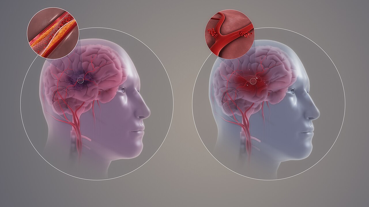 Ischemic versus hemorrhagic stroke &mdash; two mechanisms that share one clinical vocabulary of sudden deficits.