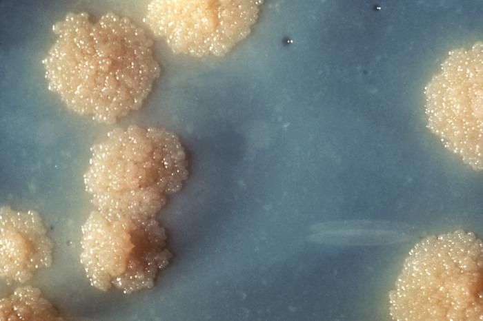 Acid-fast stained Mycobacterium tuberculosis, the cause of tuberculosis