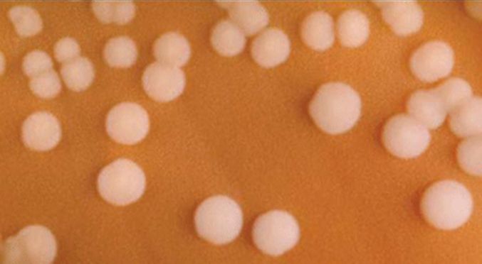 Neisseria gonorrhoeae diplococci inside white blood cells on a Gram stain