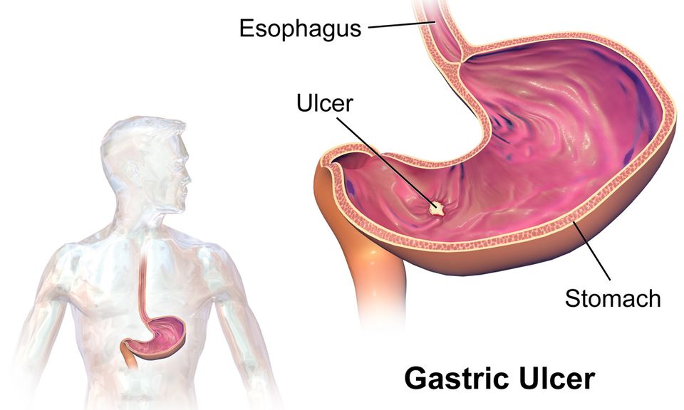 GERD & ulcers reference figure