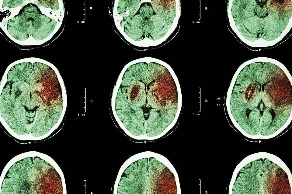 Stroke reference figure