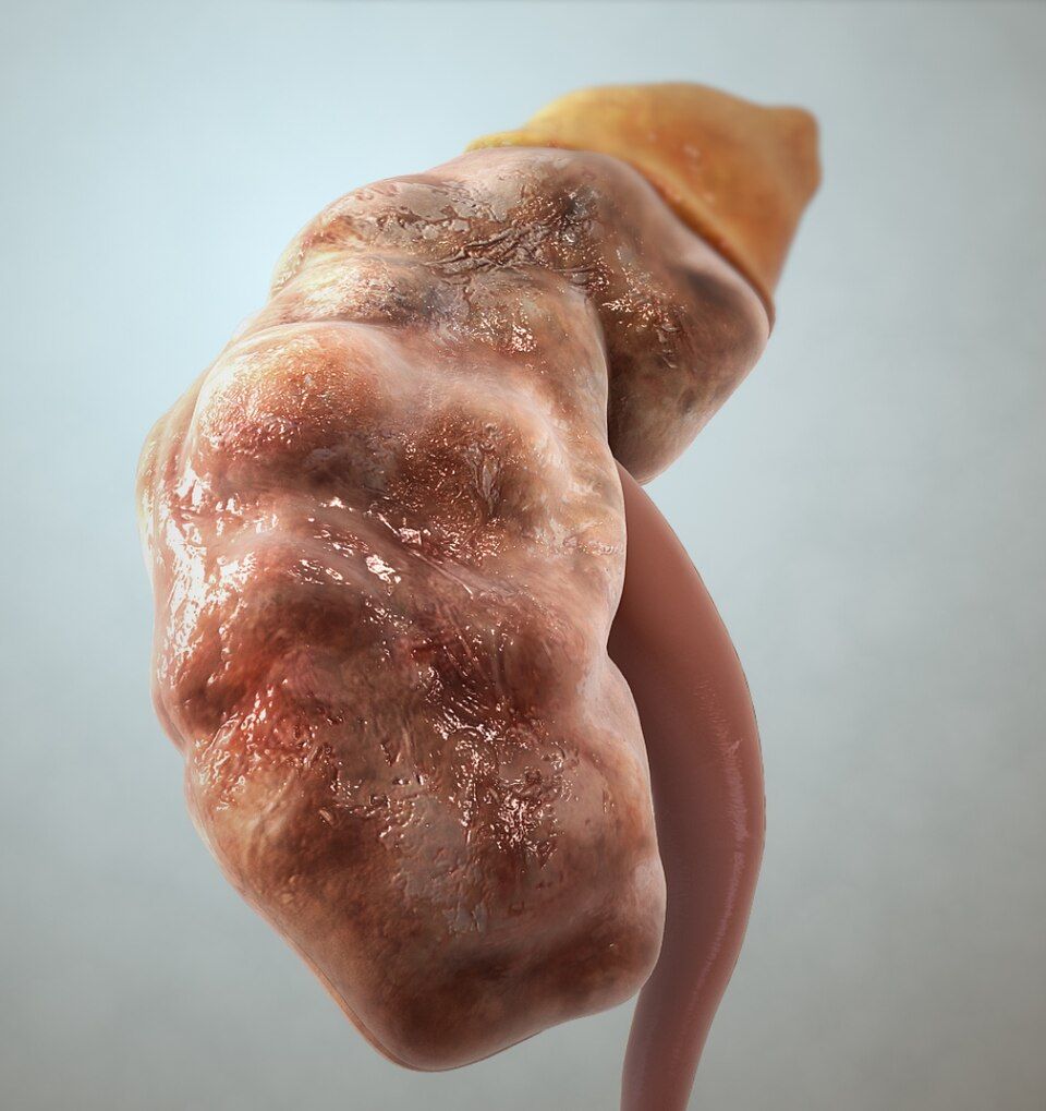 Chronic kidney disease reference figure