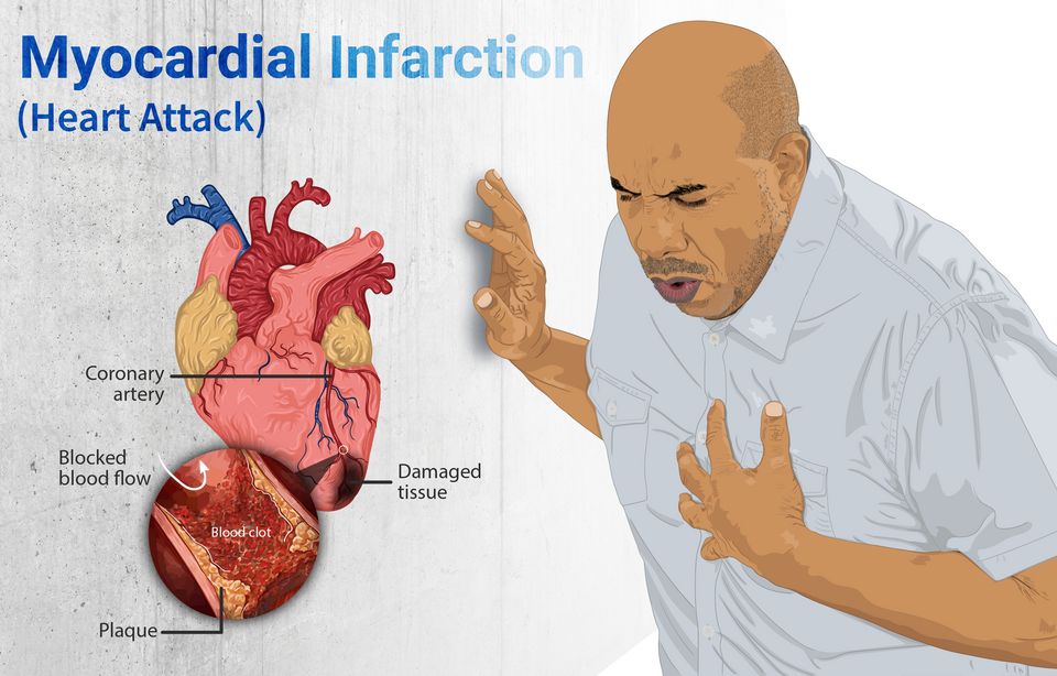 Reference figure for coronary artery disease and heart attack