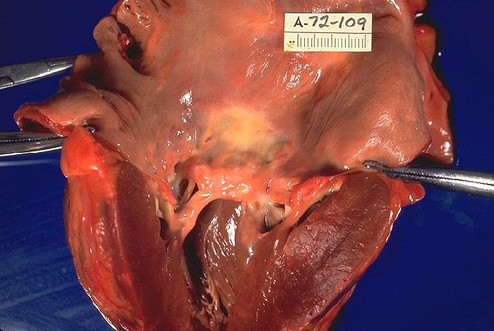 Reference figure for heart valve disorders