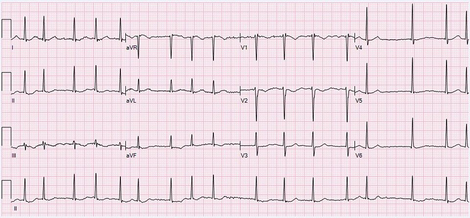 Reference figure for the EKG and arrhythmias