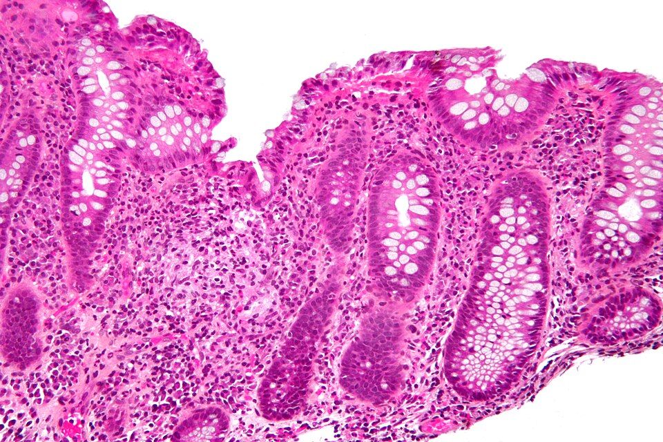Reference figure for inflammatory bowel disease