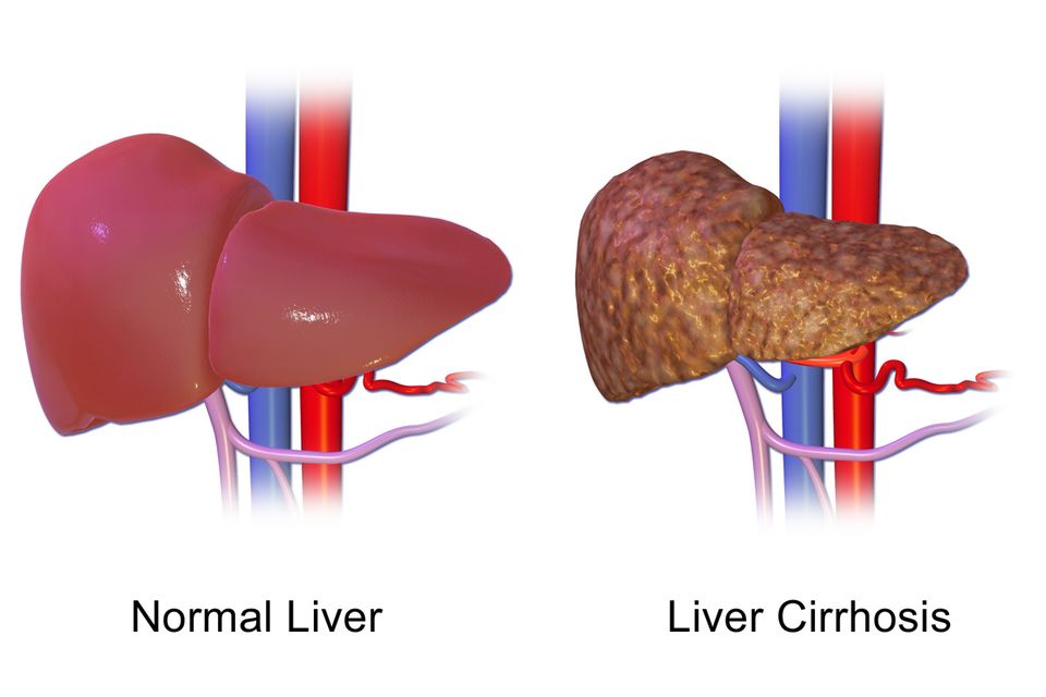 Reference figure for hepatitis and cirrhosis