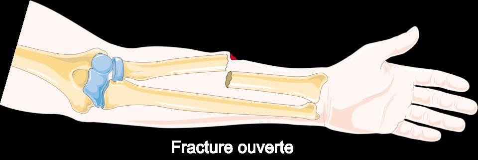 Reference figure on fractures
