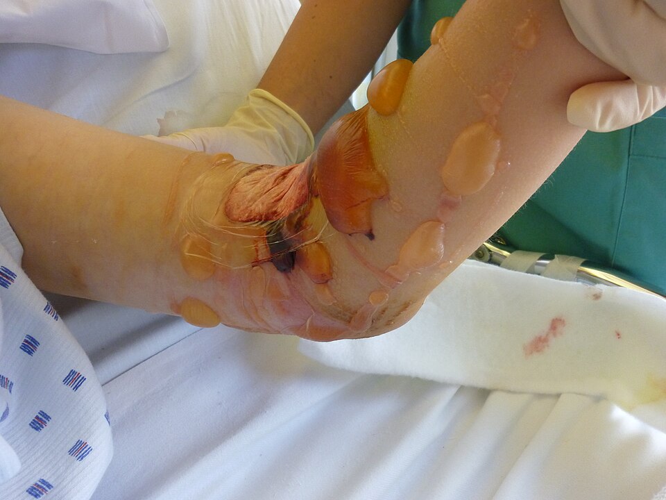Reference figure on fracture complications