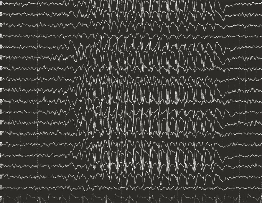 Reference figure for seizures and epilepsy