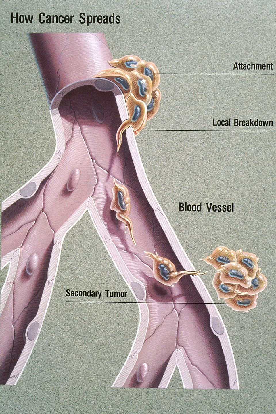 Diagram of a tumor growing, invading nearby tissue, and spreading to distant organs