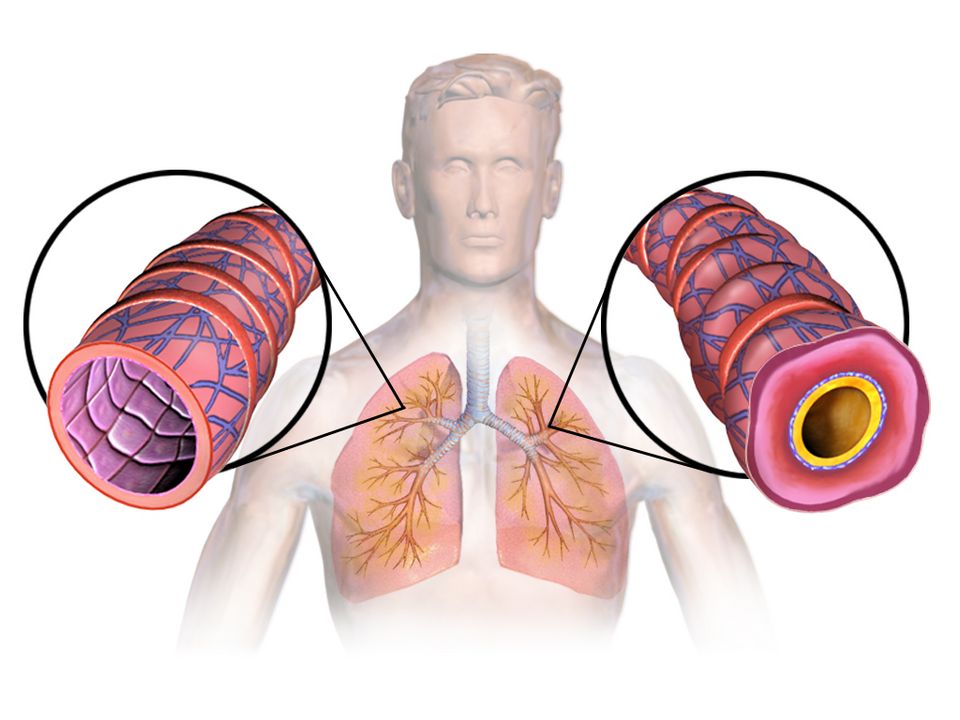 Asthma reference figure