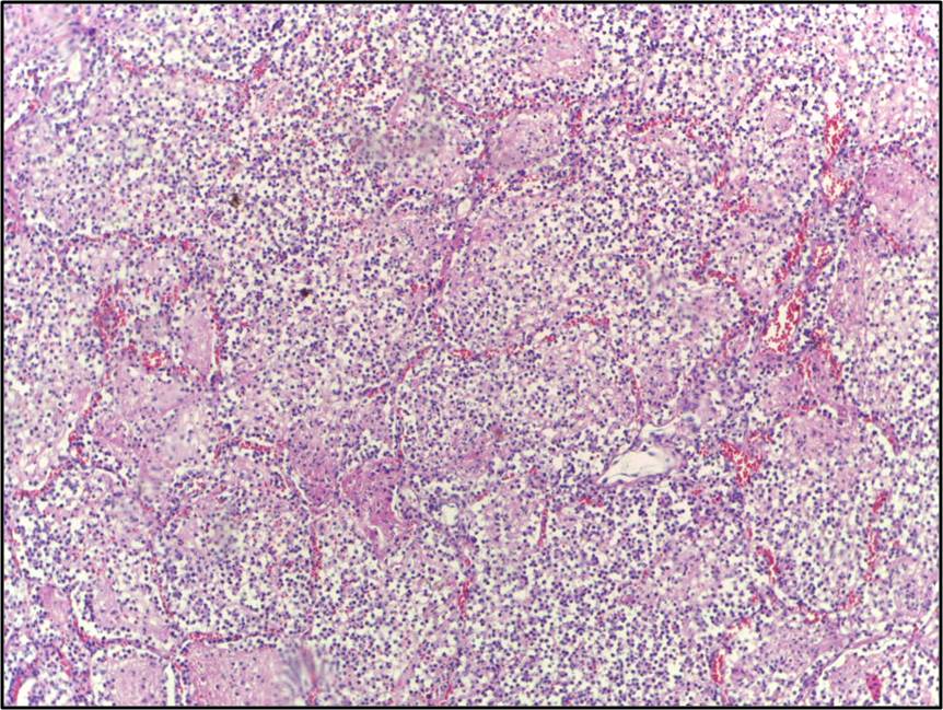 Pneumonia reference figure