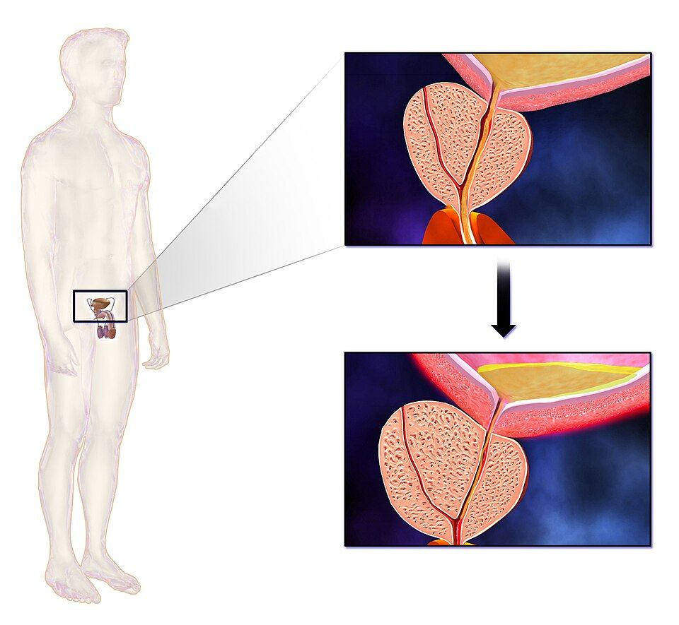 Diagram of the male reproductive organs and where common disorders occur