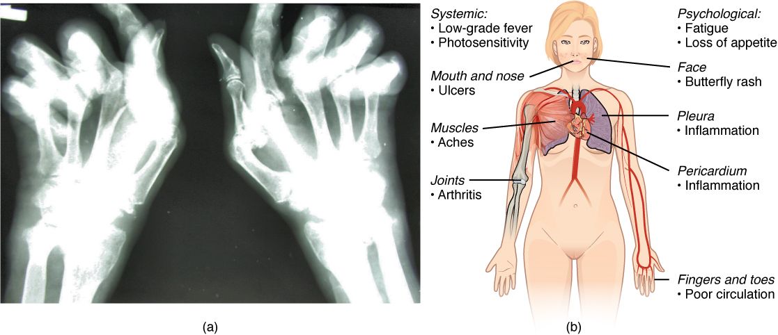 Reference figure illustrating rheumatoid arthritis as an autoimmune joint disorder